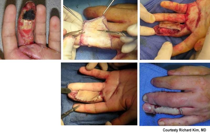 thumb flap repair Girls girls sex girls